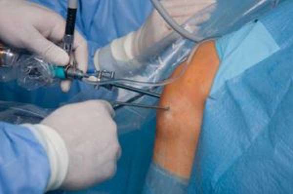 Причины и лечение контрактуры суставов